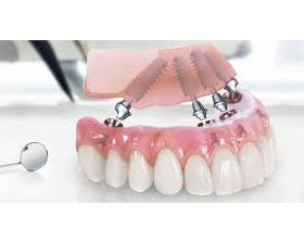 Восстановление зубного ряда нижней челюсти по системе все на четырёх