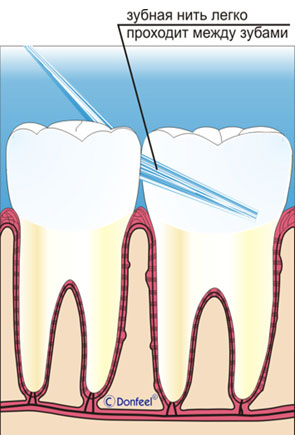 О пользе зубных нитей